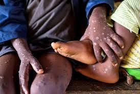 Ghana Mpox Cases